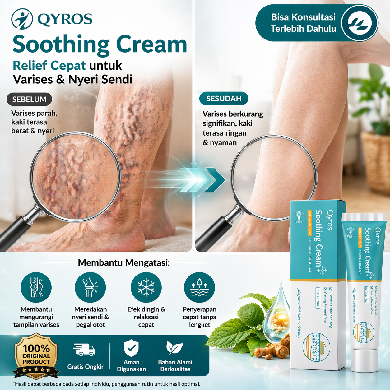 Perbandingan sebelum dan sesudah penggunaan Qyros Soothing Cream untuk varises